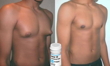 Steroids negative effects on the body